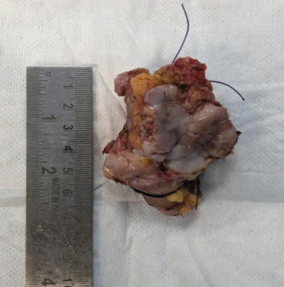 Figure 5: Excised tumor mass.