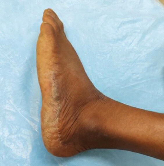 Figure 7: Lateral foot view at 6-month follow-up.