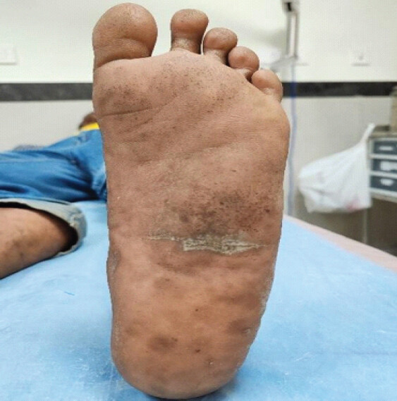 Figure 8: Plantar foot view at 6-month follow-up.
