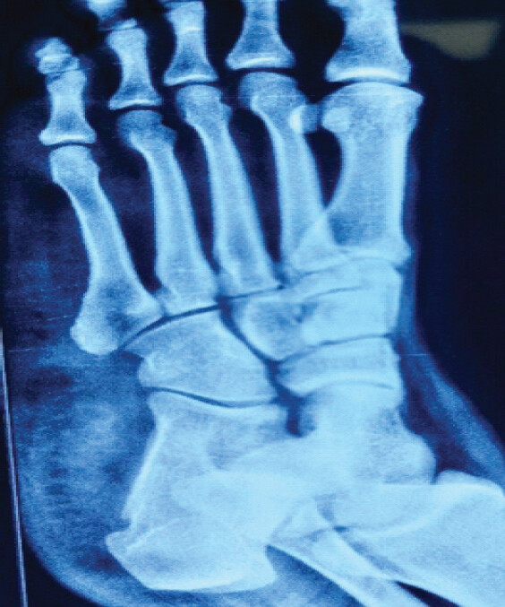 Figure 9: Two-year post-operative radiograph showing no recurrence.