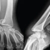 Traumatic Volar Dislocation of a Hemi-Scaphoid-Lunate Complex across the Carpal Ligament: A Case Report