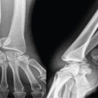 Figure 1: Posteroanterior and lateral X-ray of the left wrist showing volar trans-scaphoid perilunate fracture-dislocation migrated into the forearm.