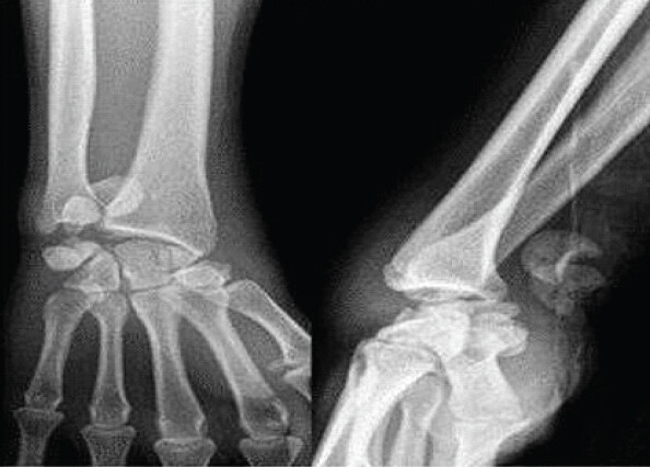 Figure 1: Posteroanterior and lateral X-ray of the left wrist showing volar trans-scaphoid perilunate fracture-dislocation migrated into the forearm.