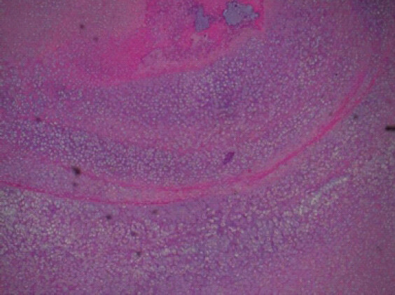 Figure 10: Histopathological microphotograph showing a lesion composed of a well-organized hyaline cartilage cap with chondrocytes arranged in clusters within lacunae. The underlying region demonstrates orderly endochondral ossification, with transition from cartilage to trabecular bone. No cytological atypia, pleomorphism, or increased mitotic activity is observed. These findings are consistent with a benign osteochondroma.