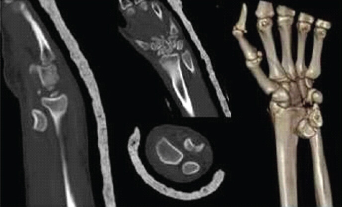 Figure 2: Computed tomography (CT) scan and CT reconstruction of the left wrist showing volar trans-scaphoid perilunate fracture-dislocation migrated into the forearm.