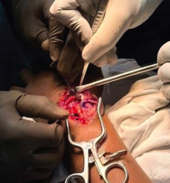 Figure 3: Intraoperative photograph showing the surgical approach used to access and mobilize the displaced lunate and proximal scaphoid.