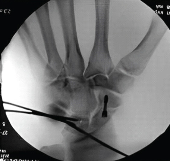 Figure 4: Intraoperative posteroanterior fluoroscopic image of the left wrist after reduction and fixation of the scaphoid with a Herbert screw and the lunate with Kirschner wires.