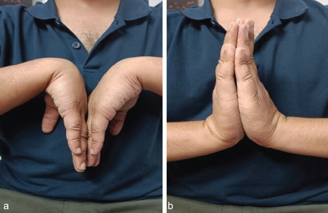 Figure 5: Clinical photographs showing wrist flexion (a) and extension (b) 12 months after injury.
