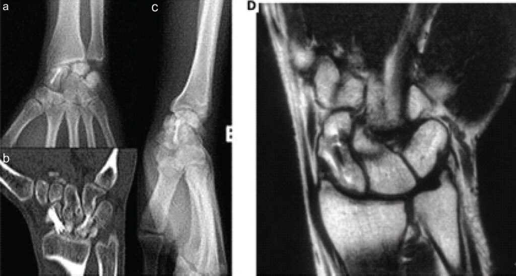 Figure 6: (a) Posteroanterior and (b) lateral X-ray, (c) computed tomography scan, and (d) coronal T2-weighted magnetic resonance imaging of the left wrist 12 months after injury, the latter showing altered marrow signal in the scaphoid and lunate that raised concern for osteonecrosis, without evidence of radiocarpal or midcarpal arthritis.