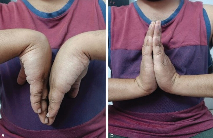 Figure 7: Clinical photographs showing wrist flexion (a) and extension (b) 3 years after injury.