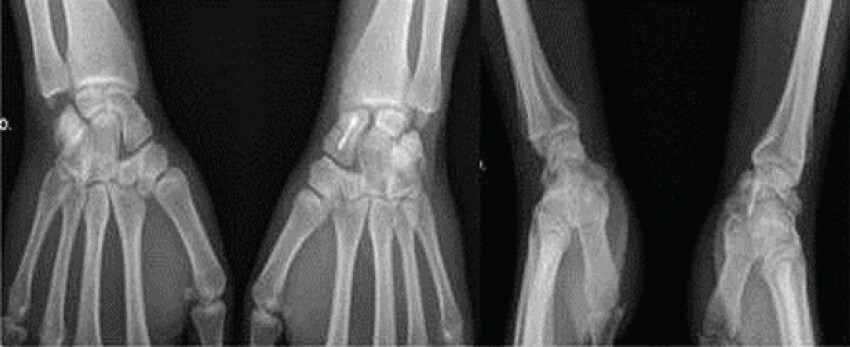 Figure 8: Posteroanterior and lateral X-rays of both wrists 3 years after injury.