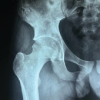 Cortical Window Osteotomy for Diagnostic Biopsy in Iliac Osteomyelitis: A Case Report and Technical Note