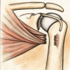 Repair of a Chronic Pectoralis Major Rupture with Achilles Tendon–Calcaneal Allograft: A Case Report