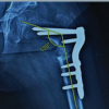 Orthopedic Intervention in an Organic Acid Disorder: Challenges in the Management of Hip Dislocation in a Child with Late Onset Methylmalonic Acidemia