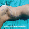 Nerve Transfers for Brachial Plexus Injury: A Pathway to Functional Restoration