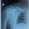 Outcome Analysis of Loop Endobutton Repair for Acromioclavicular Joint Dislocation