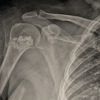 Resolution of Proximal Humerus Enchondroma in a 53-Year-Old Female with Curettage and Bone Substitution: A Case Report