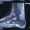 A Case Report – K Wire as Guide in Endoscopic Plantar Fascia Release for Beginners
