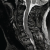 Radiologically Devastating Yet Neurologically Intact: A Rare Case of Ambulatory C6–C7 Translational Injury with Bilateral Facet Dislocation and Vertebral Artery Thrombosis