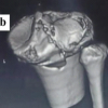 Bicruciate Ligament Avulsions, Lateral Meniscus Dual Root Avulsions – “Tibial Avulsion Tetrad” – with Menisco-capsular Injury – Floating Meniscus in Innocuous Looking Proximal Tibia Fracture