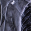 Single-Screw versus Two-Screw Fixation in the Latarjet Procedure: A Prospective Comparative Study