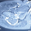 Large Posterior Proximal Femur Osteochondroma Presenting in Adulthood – Diagnostic Challenges and Management Strategy: A Case Report