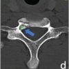 O-arm Navigation-assisted Excision of Cervical Osteoid Osteoma Adjacent to the Vertebral Artery: Technical Note and Case Report