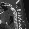 The Double Blow Phenomenon: Back-To-Back C5 Palsy in Compressive Cervical Myelopathy Surgery: A Case Series