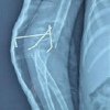 Generalized Tetanus Following Traditional Manipulation of an Open Supracondylar Humerus Fracture in a Child: A Rare Case Report