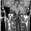 Back to Basics at the Craniovertebral Junction: Occipito-Cervical Fusion for Basilar Invagination with Atlantoaxial Instability