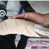 Vascularized First Dorsal Metacarpal Artery-Based Adipofascial Flap to Augment Multiple Zone VII Extensor Tendon Repairs after Glass Laceration: A Case Report