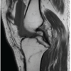 An Unusual Catastrophic Neurological Complication Following a Routine Arthroscopic Multiligament Knee Reconstruction: A Case Report