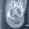 The Boba Tea Sign: A Novel Magnetic Resonance Imaging Finding in Synovial Chondromatosis of the Knee – A Case Report