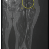 50 Years Later: Delayed Presentation of Foot Drop Due to Sciatic Nerve Neuropathy on a Background of Ipsilateral Femur Intramedullary Nailing – A Case Report