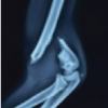Open Reduction and Internal Fixation of Gartland Type III Supracondylar Humerus Fractures Using the Posterior Paratricipital Approach: A Case Series