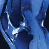 Intra-articular Ganglionic Cysts of Knee: A Cause for Anterior Knee Pain