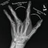 Management of Cubital Tunnel Syndrome in Split-Hand/Split-Foot Malformation: A Case Report and Review of Ulnar Nerve Dependence in Cleft Hand Prehension