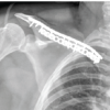 Recurrent Midshaft Clavicle Nonunion with a Large Segmental Bone Defect Treated with Autologous Iliac Crest Bone Graft and Dual Plating: A Case Report