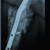 Combined Mechanical and Biological Salvage of Recalcitrant Subtrochanteric Non-union using Valgus Osteotomy, Blade Plate Fixation, and Endomedullary Fibular Graft