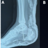Medial Subtalar Joint Dislocation in an 18-Year-Old Athlete with Pes Planus: Beyond A Simple Misstep