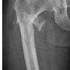 Evaluation of Orthopedic Outcomes of Proximal Femoral Nailing for Intertrochanteric Fractures and Predictive Value of Pre-operative Glycemic Status, Neutrophil-to-Lymphocyte Ratio and Platelet-to-Lymphocyte Ratio: A Prospective Study