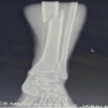 A Prospective Analysis of Physeal-Sparing Intramedullary Interlocking Nail for Adolescent Tibial Shaft Fractures