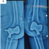 Why the Ilizarov Ring Fixator Remains the Preferred Technique for Knee Arthrodesis in Complex Knee Conditions: A Case Series