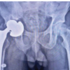 Outcome of Large-Diameter Jumbo Cups or Acetabular Mesh with Impaction Bone Grafting for Acetabular Defects in Primary and Revision Total Hip Arthroplasty: A Case Series