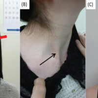 Figure 1: [A] Frontal view at initial visit: The right shoulder was slightly elevated, and the neck was in a torticollis position with right-side tilting and left rotation at rest. There was facial asymmetry. [B] Enlarged right neck at initial visit: A hard mass was noted in the right sternocleidomastoid muscle (black arrow). [C] Frontal view after surgery: The right shoulder remained elevated, and right-side tilting at rest improved.