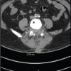 Metastatic Lung Cancer to Non-vascular Soft Tissue and Lumbar Spine Mimicking Postoperative Scar at L4–5 Non-union: A Case Report