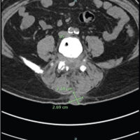 Figure 1: Axial Lumbar Spine CT without Contrast (July 2025). Axial lumbar spine CT without contrast demonstrating interval resorption of the osseous fragment/bony graft at the laminectomy bed with soft-tissue density extending to the intraspinal canal, inseparable and difficult to delineate from the thecal sac within the limitation of lack of contrast. A posterior soft-tissue mass measuring 2.14 by 2.69 cm and superficial to the deep spinal fascia is also seen.