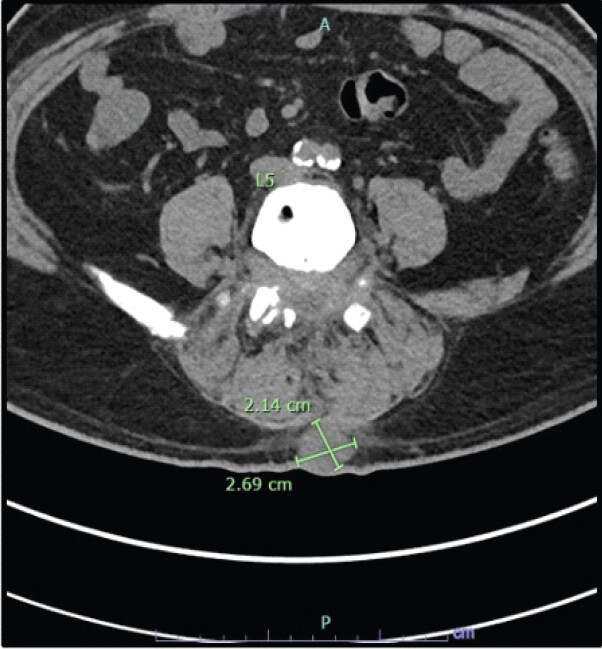 Figure 1: Axial Lumbar Spine CT without Contrast (July 2025). Axial lumbar spine CT without contrast demonstrating interval resorption of the osseous fragment/bony graft at the laminectomy bed with soft-tissue density extending to the intraspinal canal, inseparable and difficult to delineate from the thecal sac within the limitation of lack of contrast. A posterior soft-tissue mass measuring 2.14 by 2.69 cm and superficial to the deep spinal fascia is also seen.