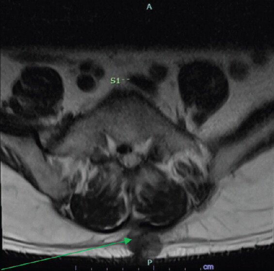 Figure 2: Axial Lumbar Spine Magnetic Resonance Imaging without Contrast (August 2025). Indeterminate T2 hypointense soft-tissue density within the posterior subcutaneous soft tissue at the S1 level as seen on the axial series, indicated by the arrow.