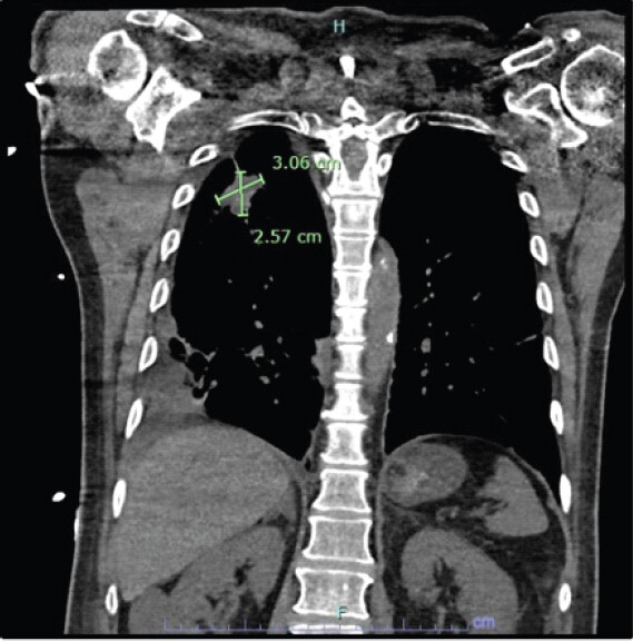 Figure 3: Coronal Chest CT without Contrast (August 2025). Irregular spiculated right upper lobe pulmonary mass with internal cavitation measuring 3.0 x 2.6 cm in the largest coronal dimensions, highly concerning for primary lung malignancy. The lesion abuts the adjacent posterior pleura.